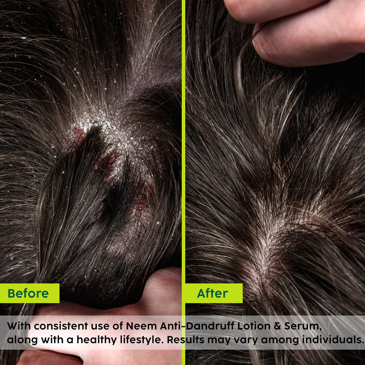Plix Neem Anti-Dandruff Advanced Hair Serum (Helps Reduce Dandruff, Scalp Itching & Irritation)