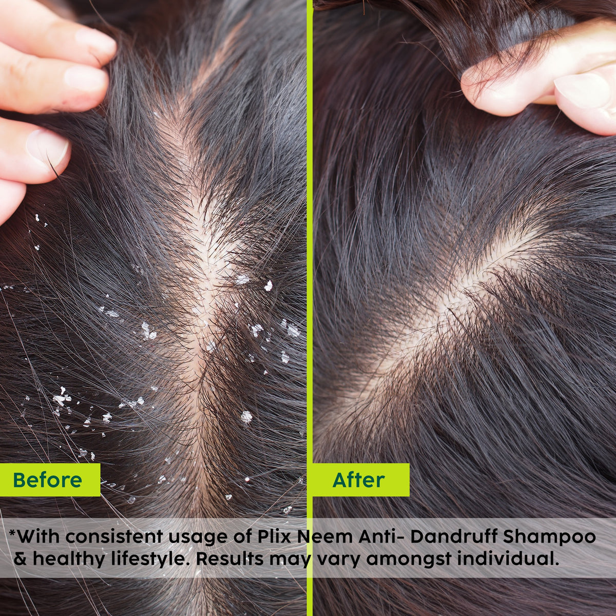 Plix Neem Advanced Anti-Dandruff Shampoo