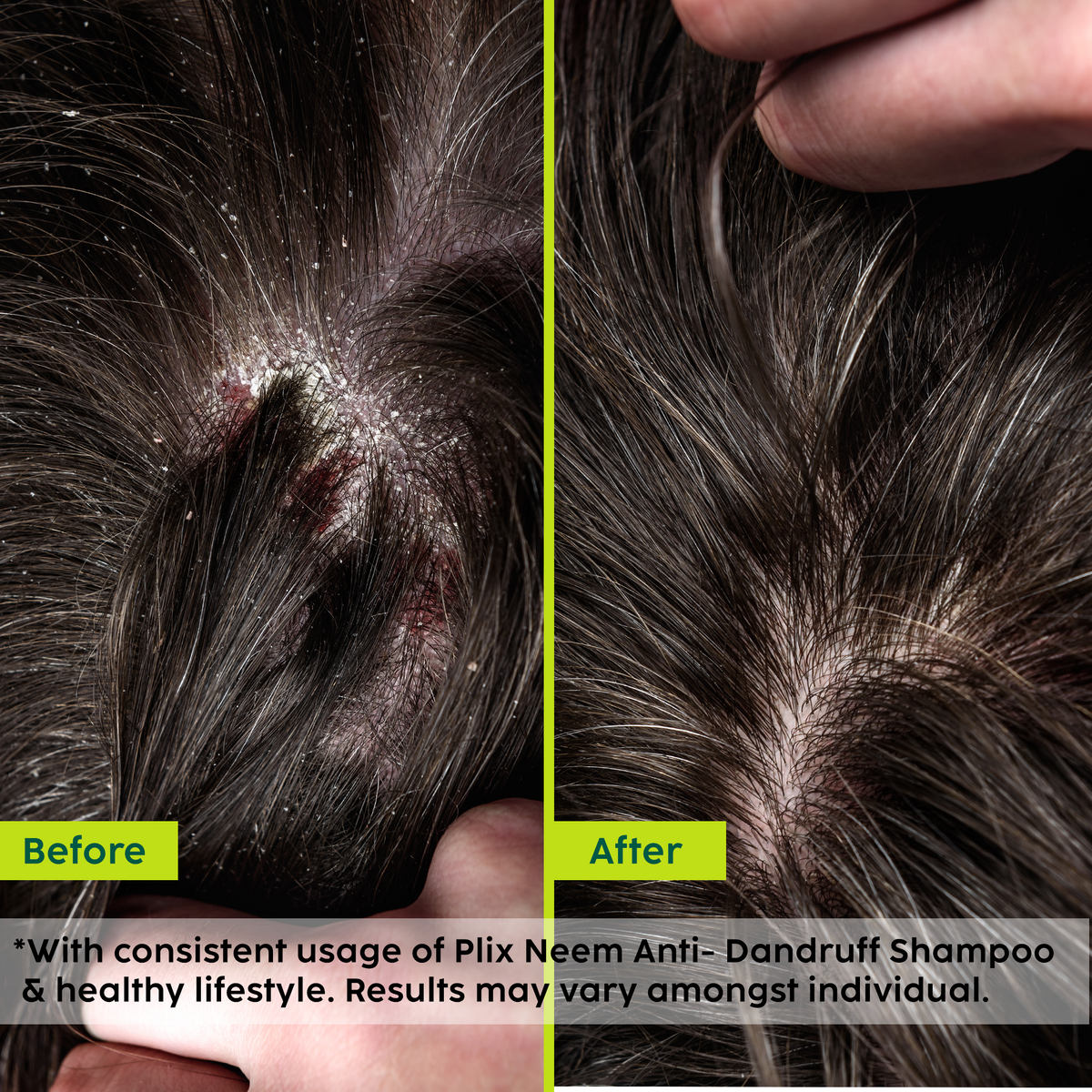 Plix Neem Advanced Anti-Dandruff Shampoo