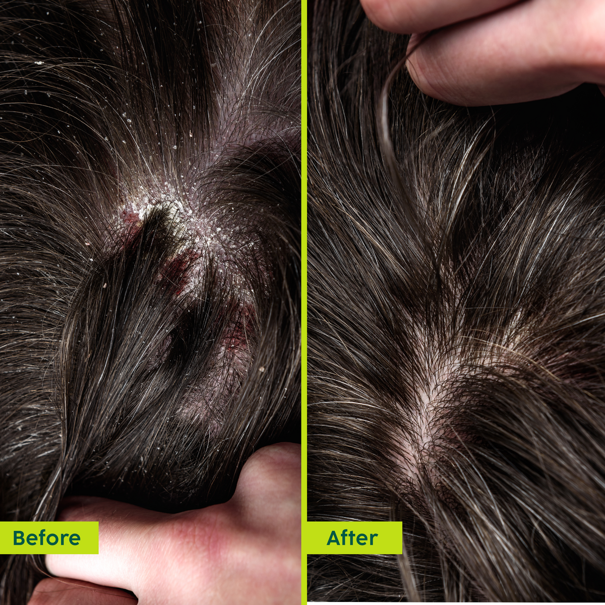 Plix Neem Advanced Anti-Dandruff Hair Oil