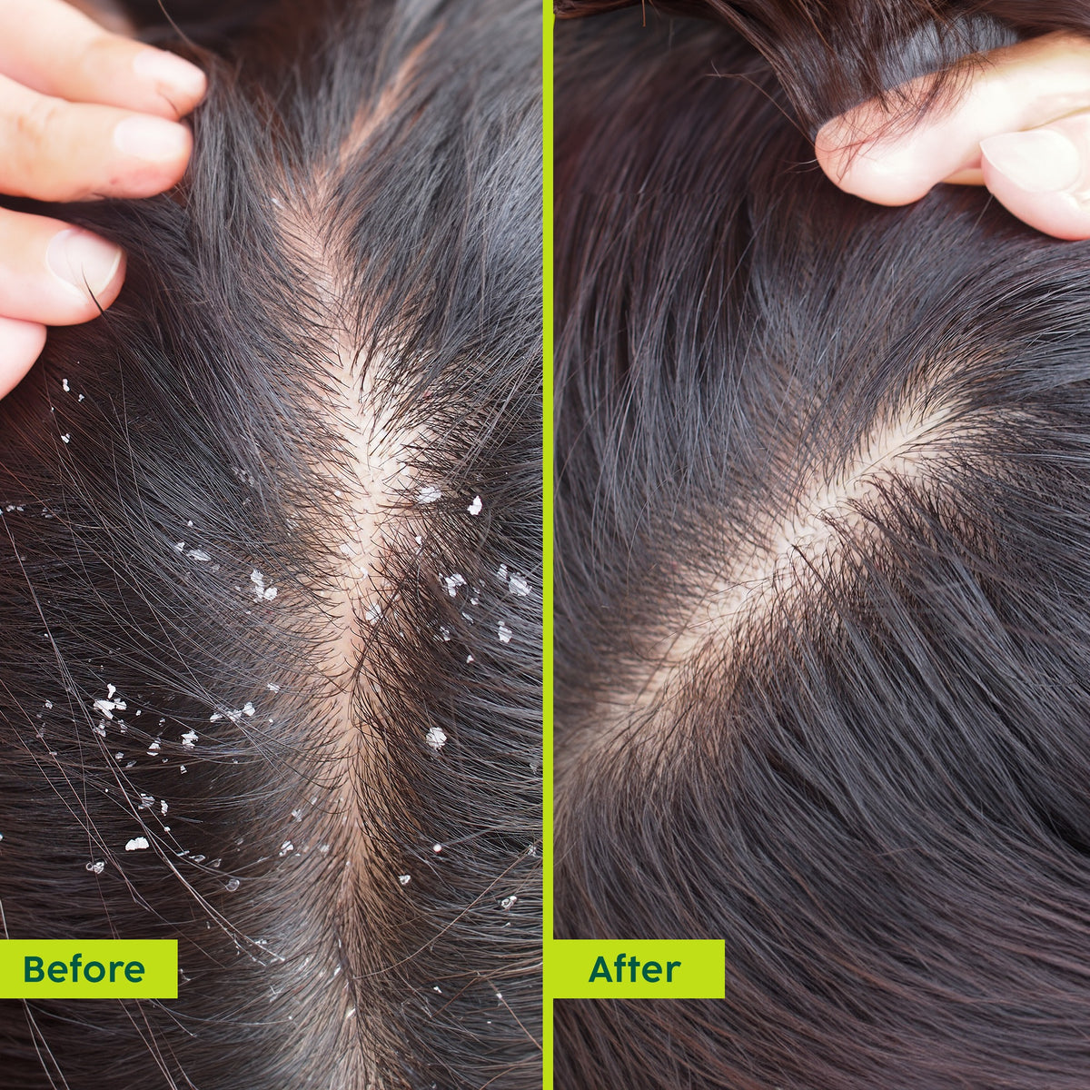 Plix Neem Advanced Anti-Dandruff Hair Oil