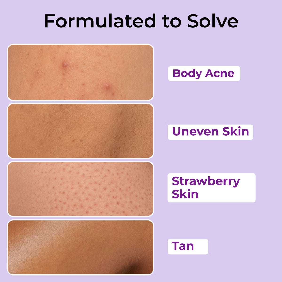Foxtale Hula Hoop 2% Salicylic Acid Exfoliating Body Wash for Body Acne, Strawberry & Bumpy Skin